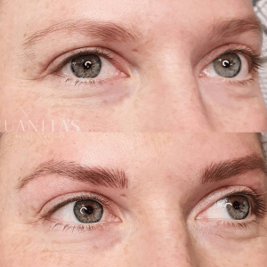 Brow treatment