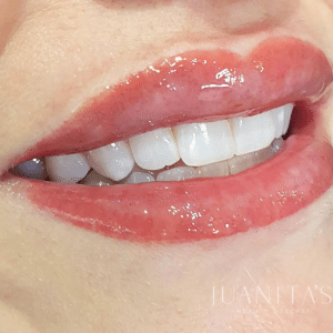 after lip treatment