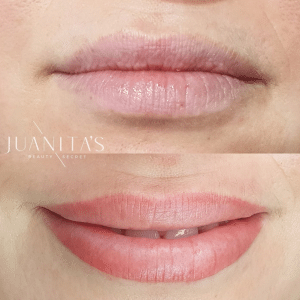 before after lip treatment